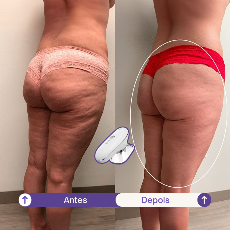 SculpLift - Dispositivo 3 em 1 para Flacidez Localizada