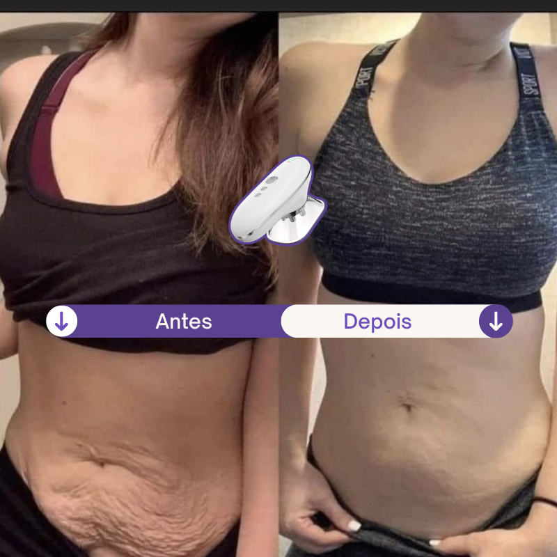 ScupLift - Dispositivo 3 em 1 para Flacidez Localizada