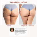 Antes e depois de 4 semanas de uso do Drena Roller mostrando melhora na aparência da pele e redução de inchaço causado pelo lipedema