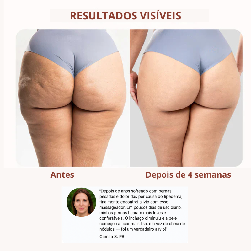 Antes e depois de 4 semanas de uso do Drena Roller mostrando melhora na aparência da pele e redução de inchaço causado pelo lipedema