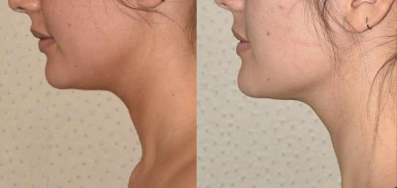 DrenaFace – Escova de Drenagem Linfática Facial