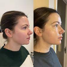 DrenaFace – Escova de Drenagem Linfática Facial