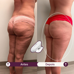 SculpLift - Dispositivo 3 em 1 para Flacidez Localizada