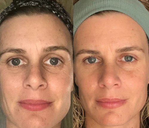 Rosto de frente, antes e depois do uso da DrenaFace