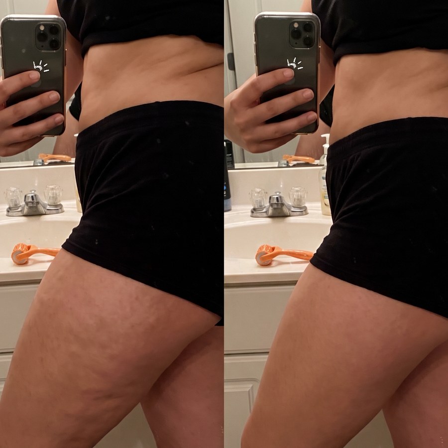 Coxa de lado, antes e depois do uso do DrenaRoller