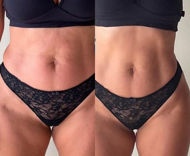 Abdômen de frente, antes e depois do uso do SculpLift
