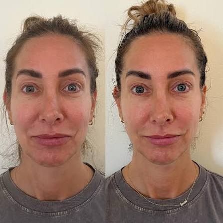 Rosto de frente, antes e depois do uso da DrenaFace