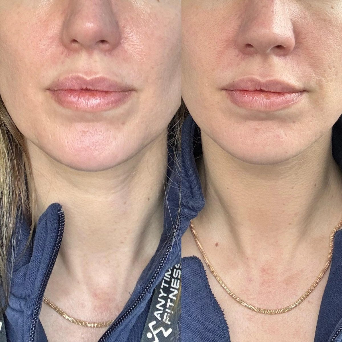 Queixo e pescoço, antes e depois do uso da DrenaFace